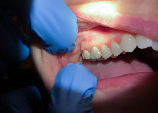 Best Emergency Tooth Extraction in Fairfax, OH